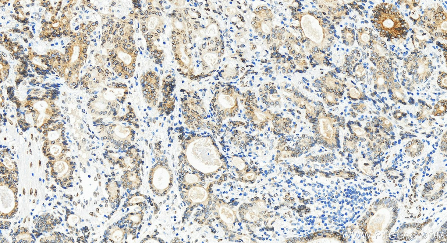 IHC staining of human stomach cancer using 82888-3-RR (same clone as 82888-3-PBS)