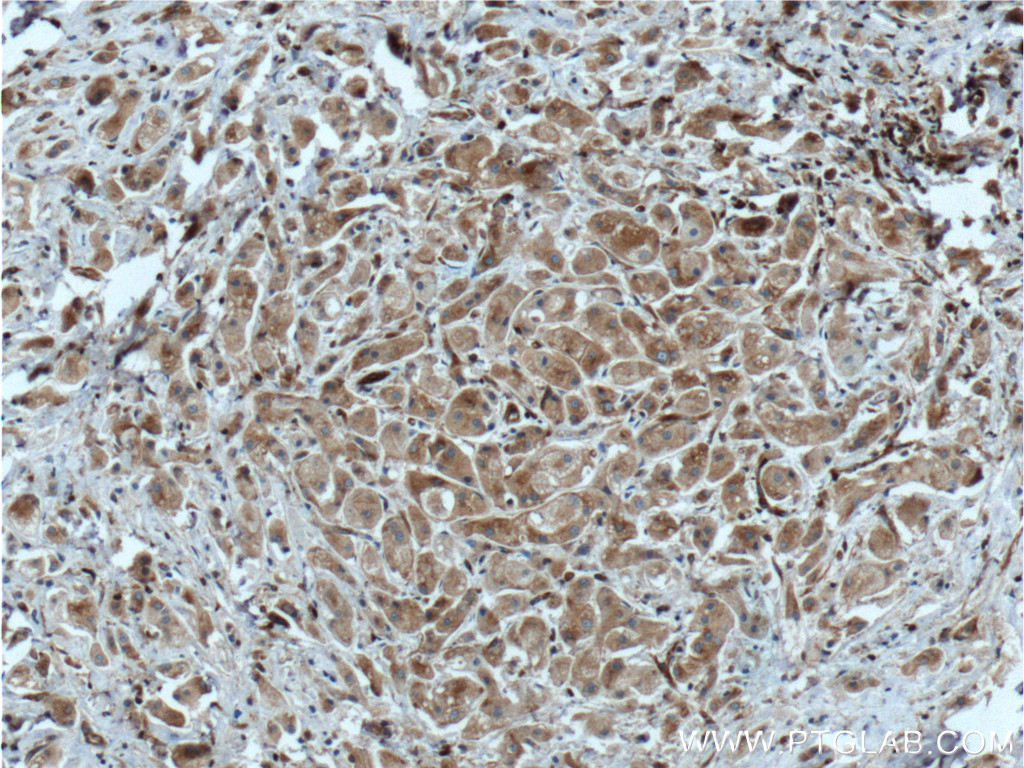 IHC staining of human breast cancer using 22709-1-AP