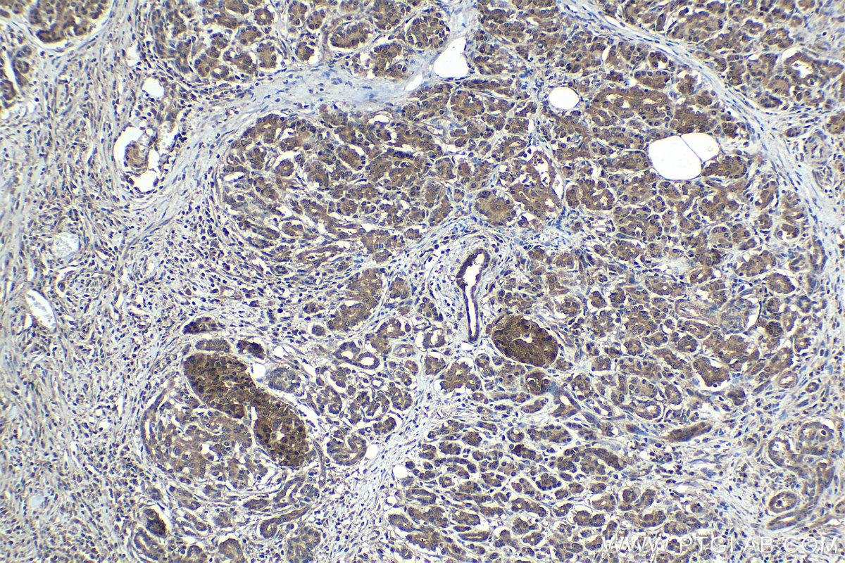 IHC staining of human pancreas cancer using 15007-1-AP IHC staining of human pancreas cancer using 15007-1-AP
