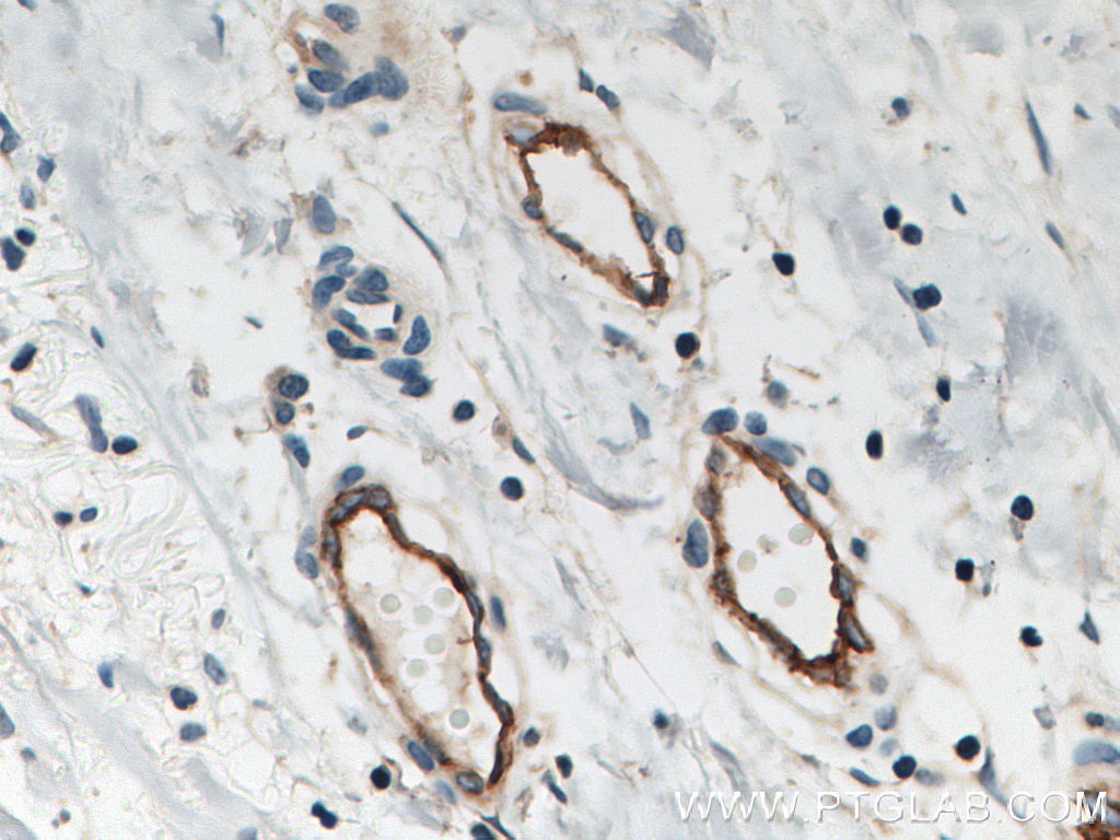 IHC staining of human breast cancer using 10862-1-AP