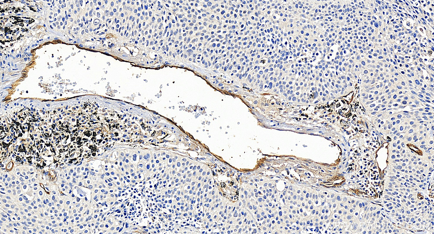 IHC staining of human lung cancer using 10862-1-AP