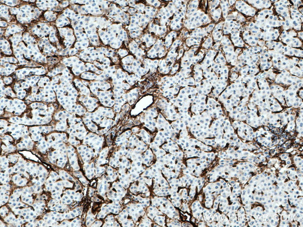 IHC staining of human liver cancer using 28117-1-AP