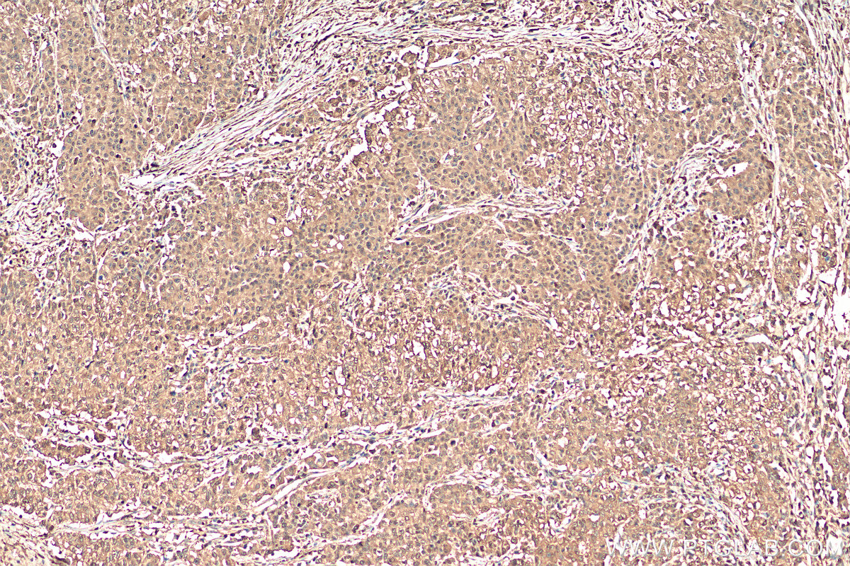 IHC staining of human stomach cancer using 11204-1-AP