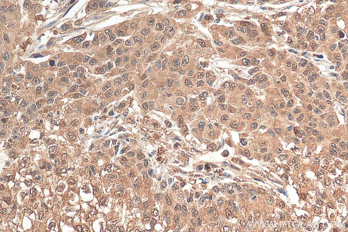 IHC staining of human stomach cancer using 11204-1-AP