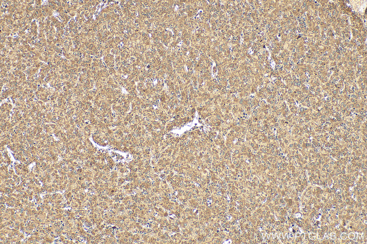 IHC staining of human liver cancer using 14243-1-AP