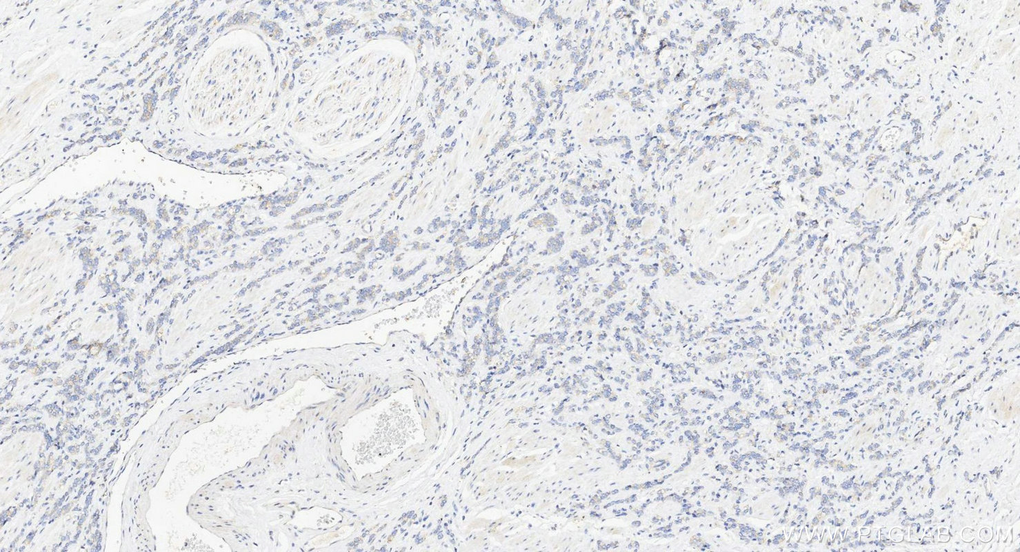 IHC staining of human prostate cancer using 11626-1-AP IHC staining of human prostate cancer using 11626-1-AP