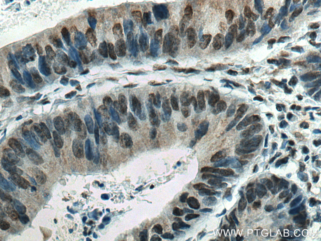 IHC staining of human colon cancer using 66731-1-Ig