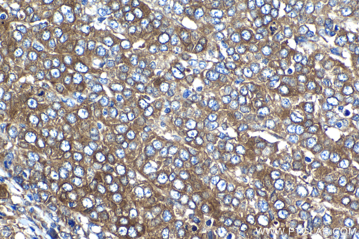 IHC staining of human ovary tumor using 15437-1-AP