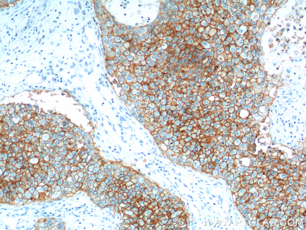 IHC staining of human breast cancer using 66316-1-Ig (same clone as 66316-1-PBS)