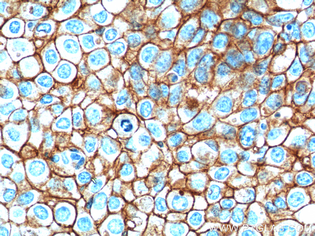 IHC staining of human breast cancer using 66316-1-Ig (same clone as 66316-1-PBS)