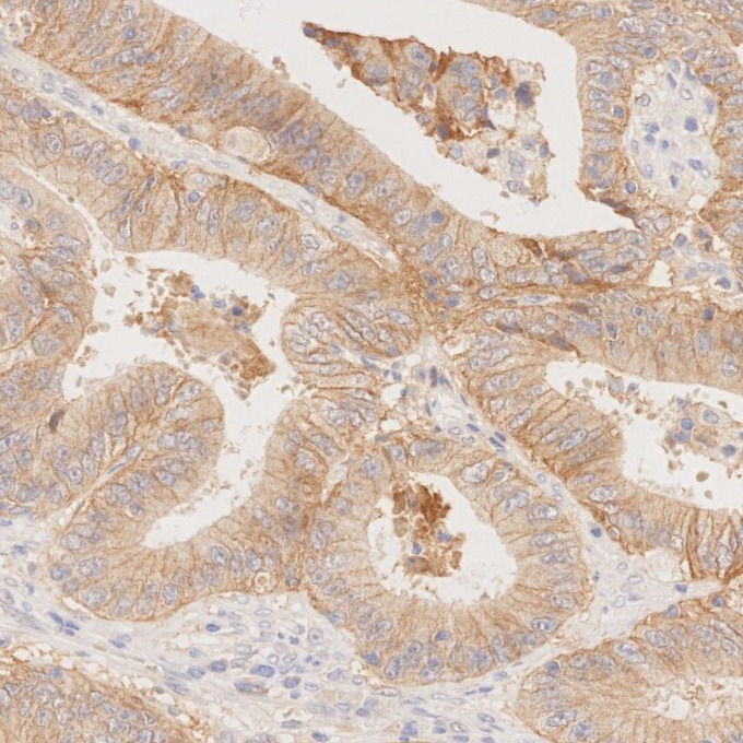 IHC staining of human colorectal cancer using 84073-6-RR