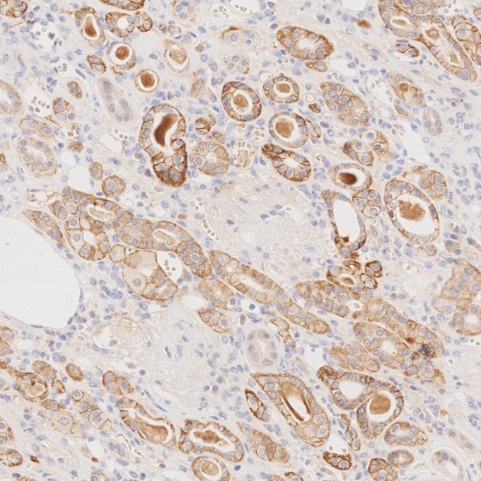 IHC staining of human renal cell carcinoma using 84073-6-RR