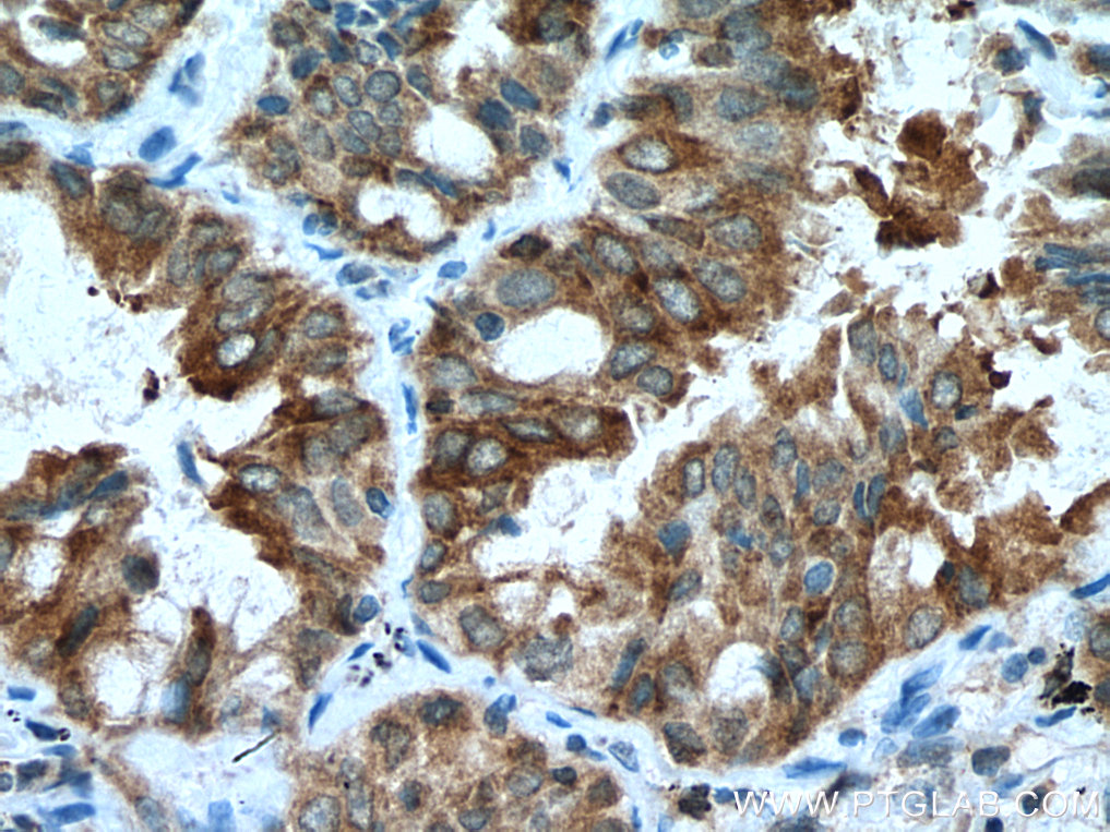 IHC staining of human lung cancer using 20883-1-AP
