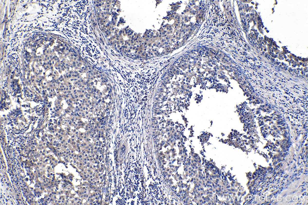 IHC staining of human breast cancer using 67322-1-Ig