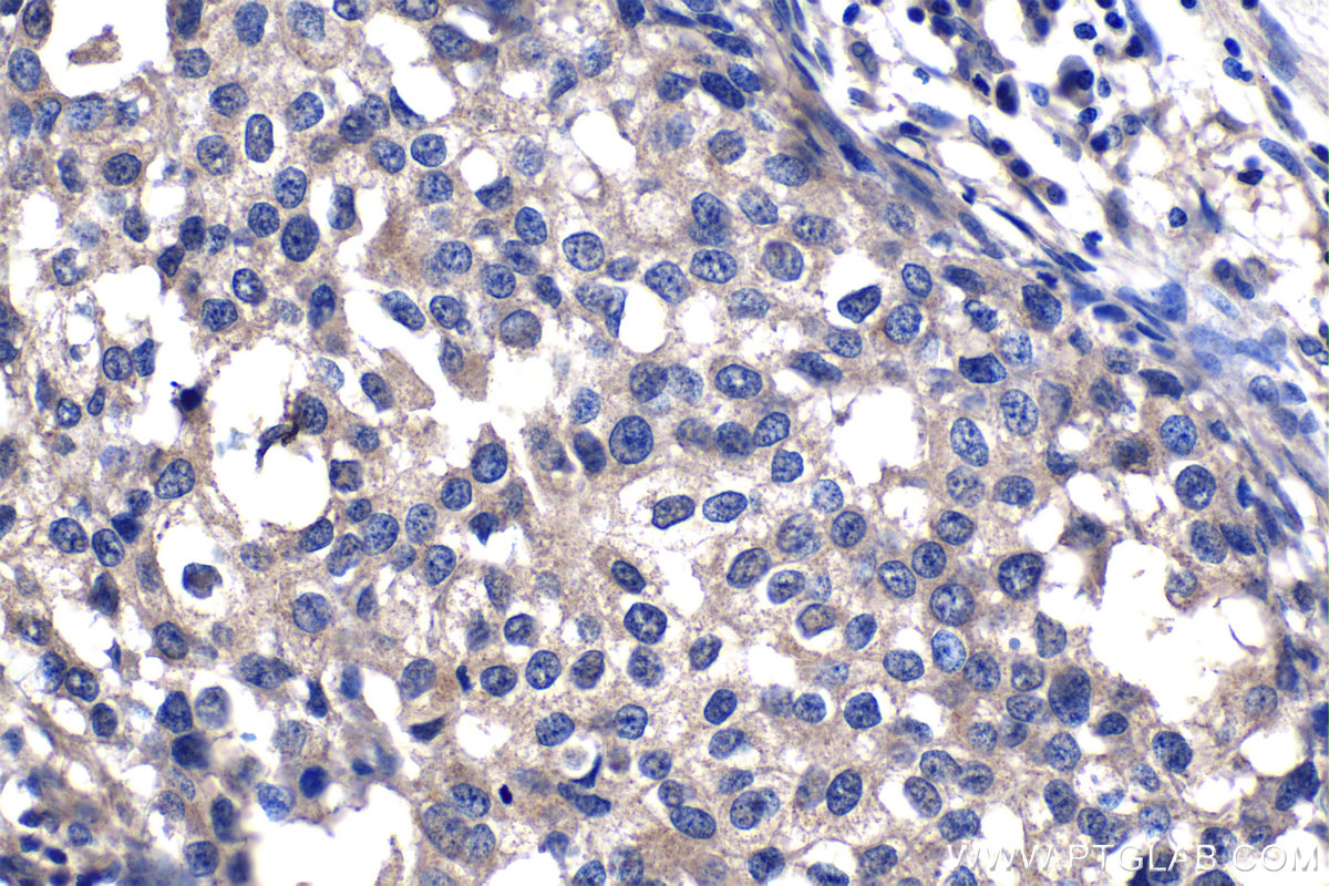 IHC staining of human breast cancer using 67322-1-Ig