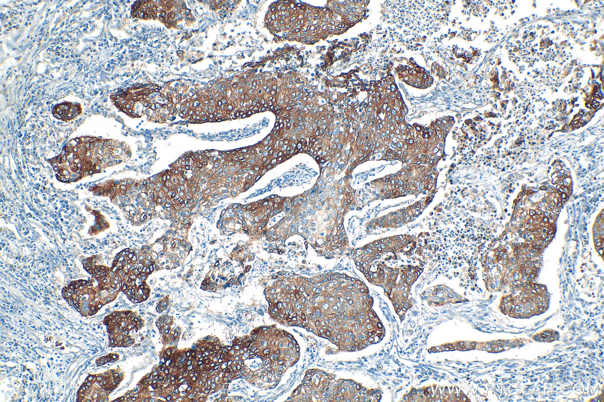 IHC staining of human lung cancer using 31475-1-AP