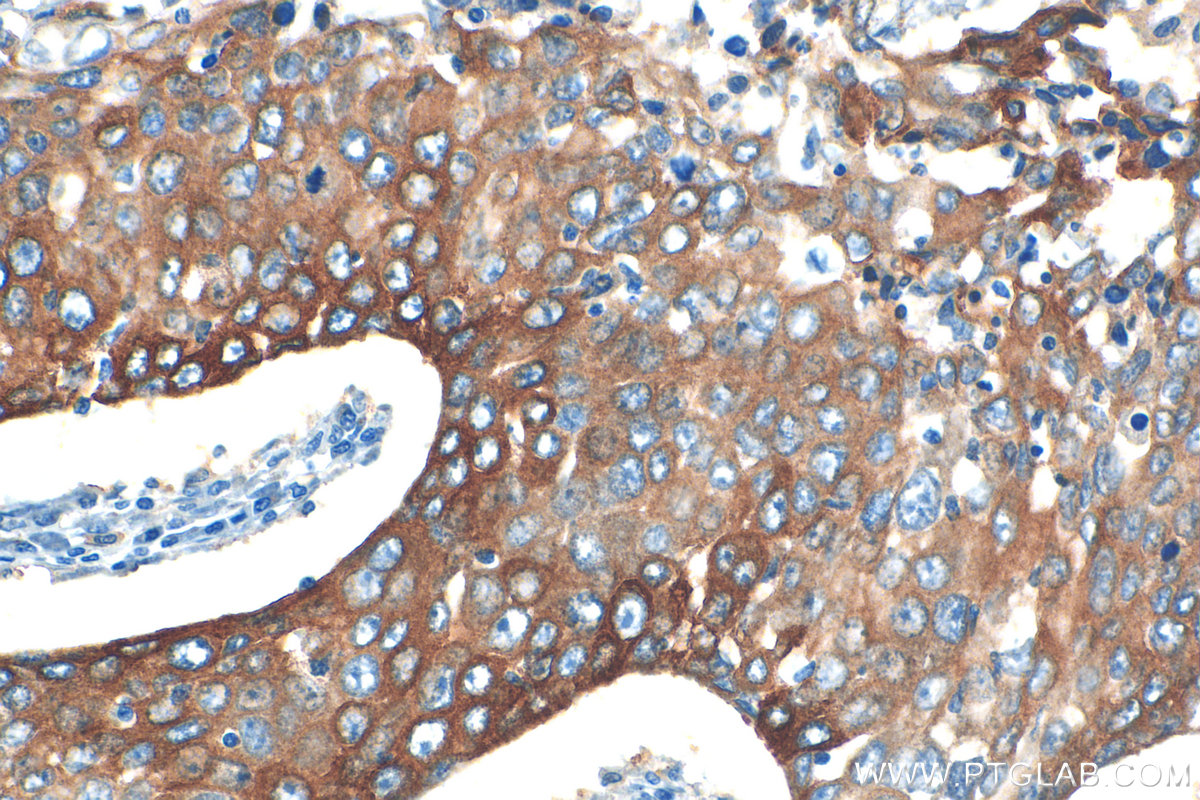 IHC staining of human lung cancer using 31475-1-AP