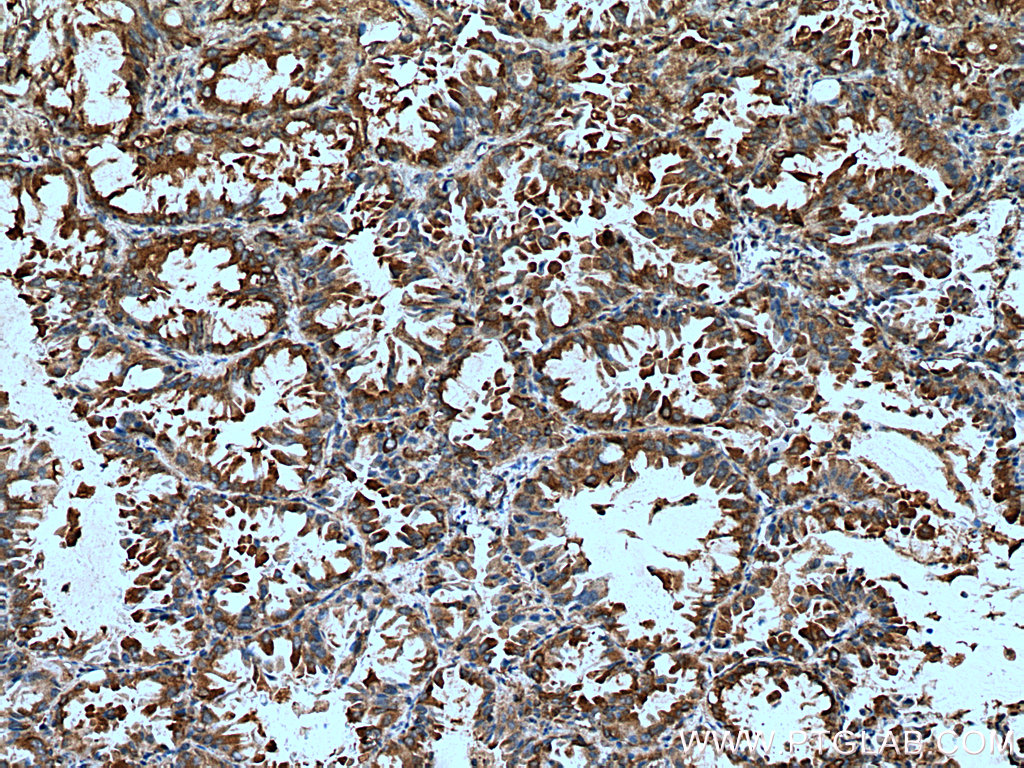 IHC staining of human lung cancer using 67712-1-Ig