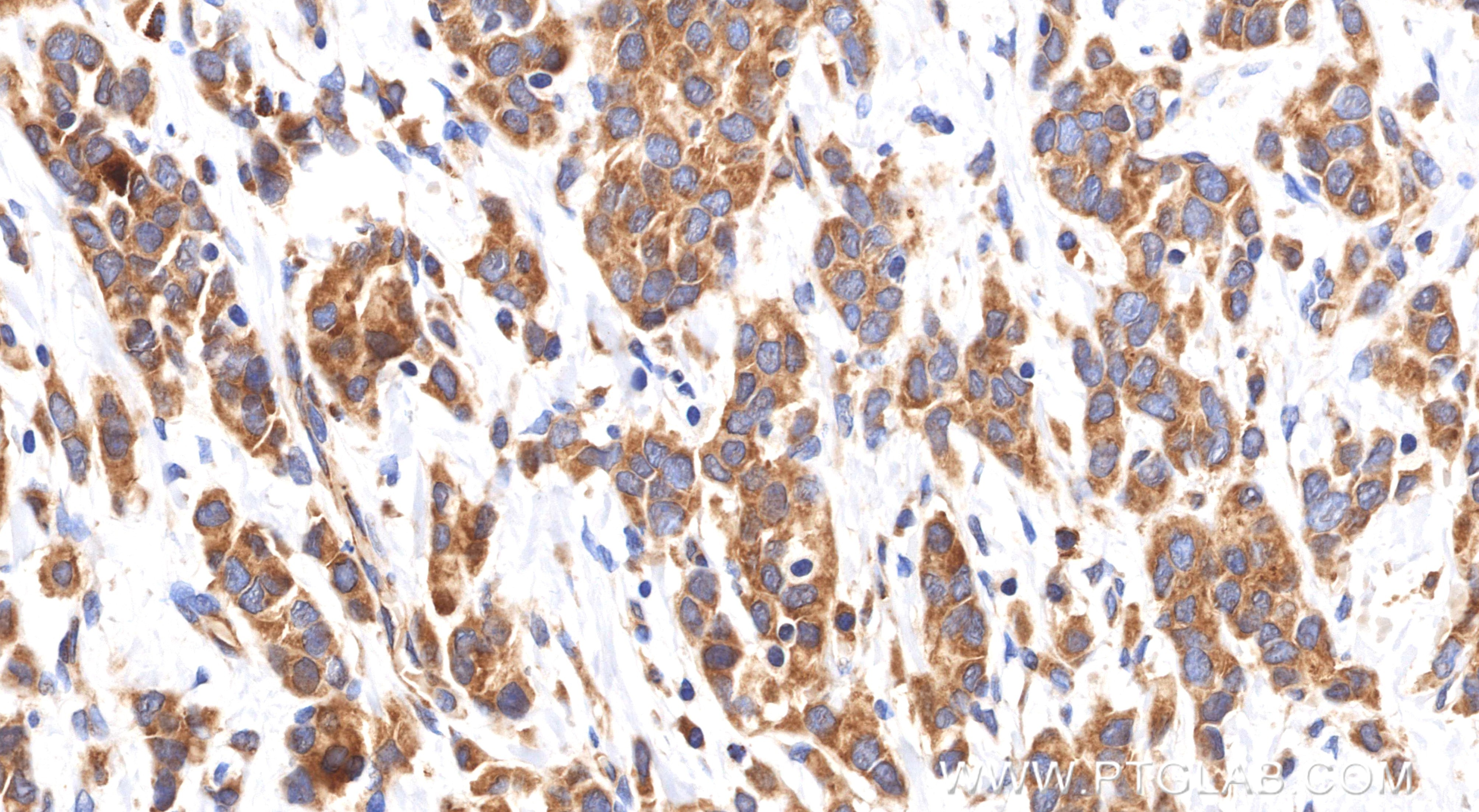 IHC staining of human breast cancer using 85184-5-RR