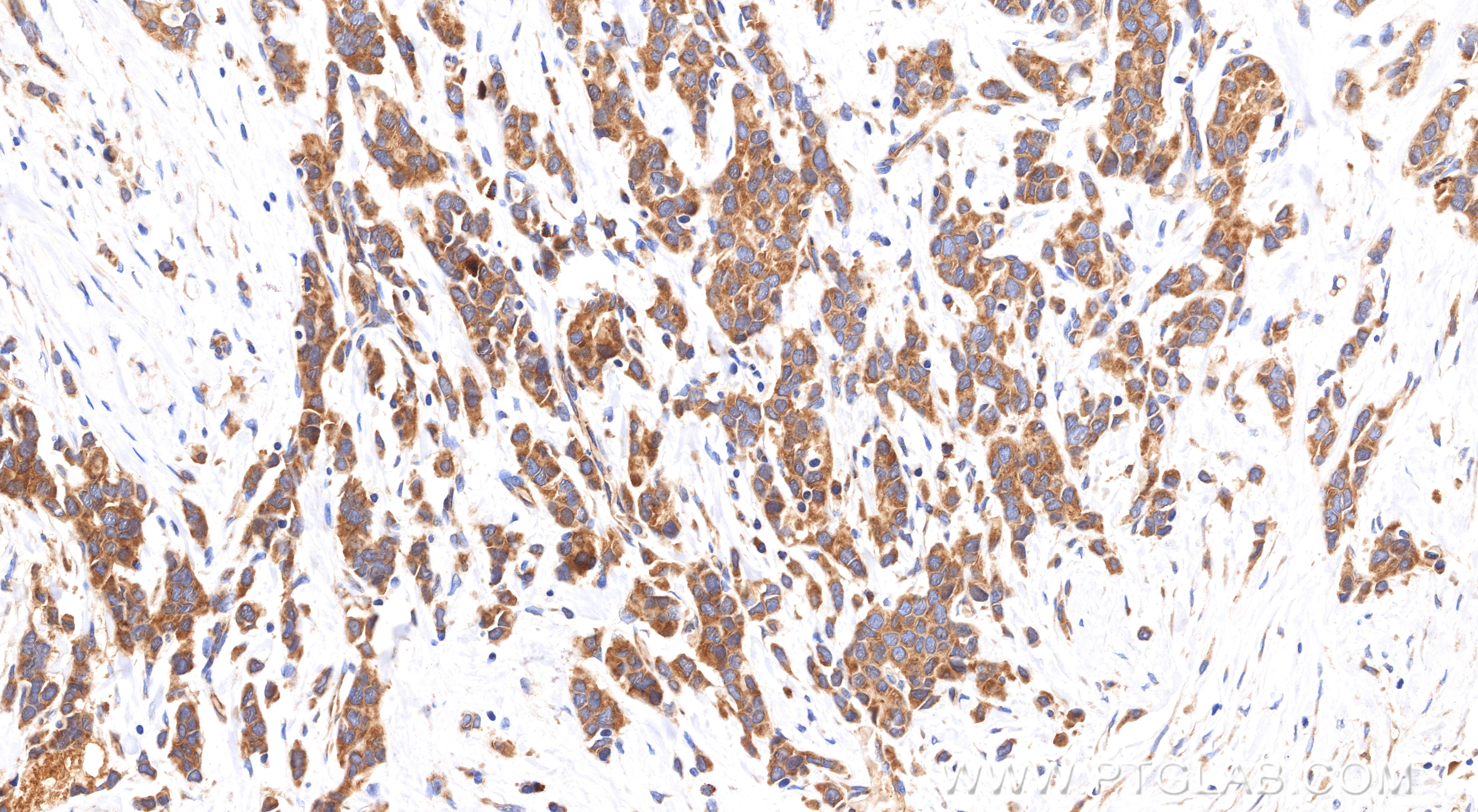 IHC staining of human breast cancer using 85184-5-RR