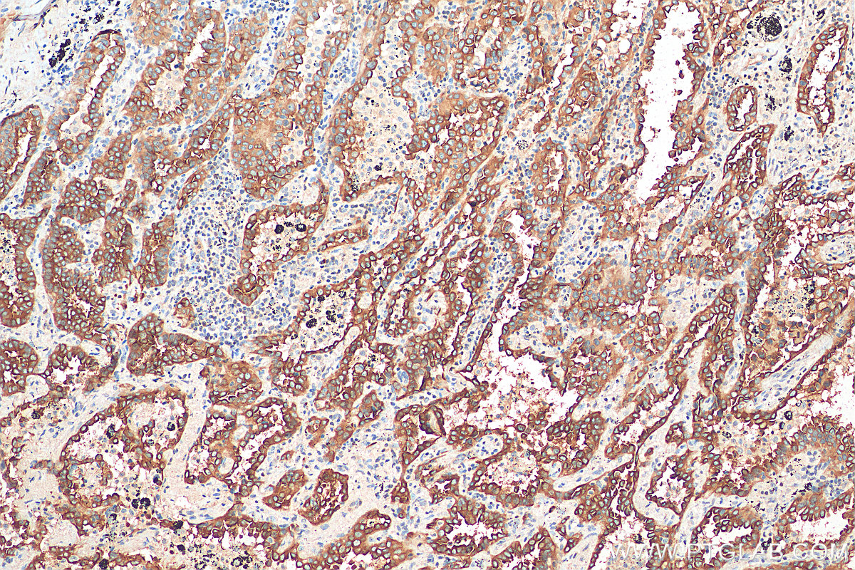 IHC staining of human lung cancer using 20461-1-AP