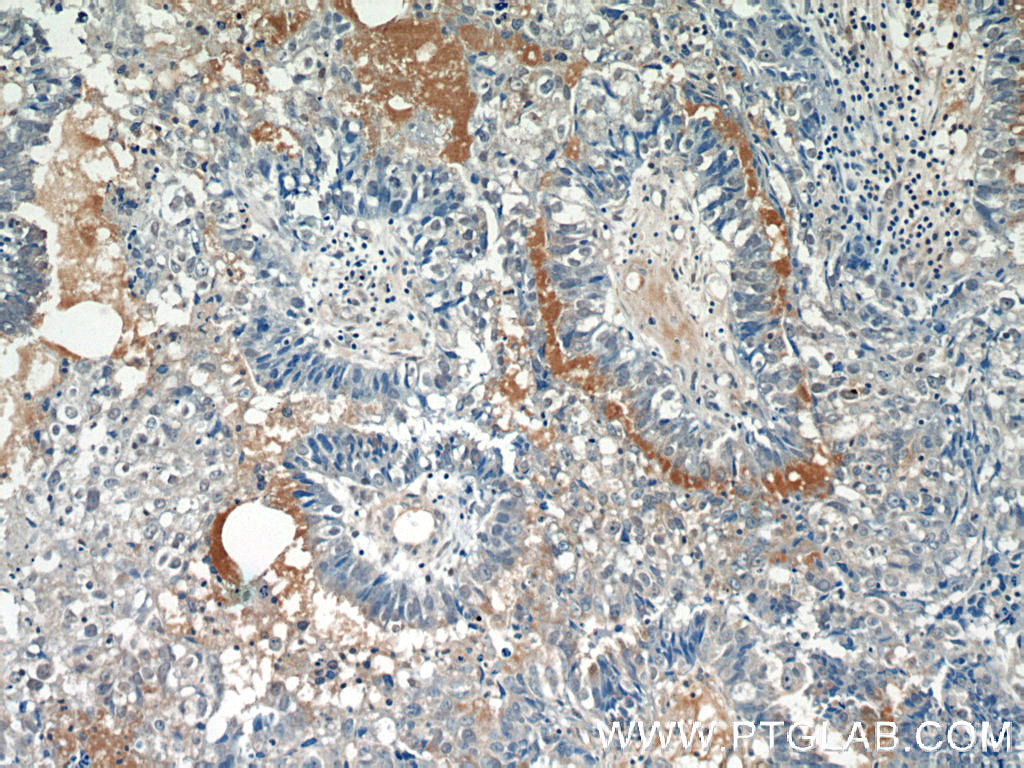 IHC staining of human breast cancer using 11627-1-AP