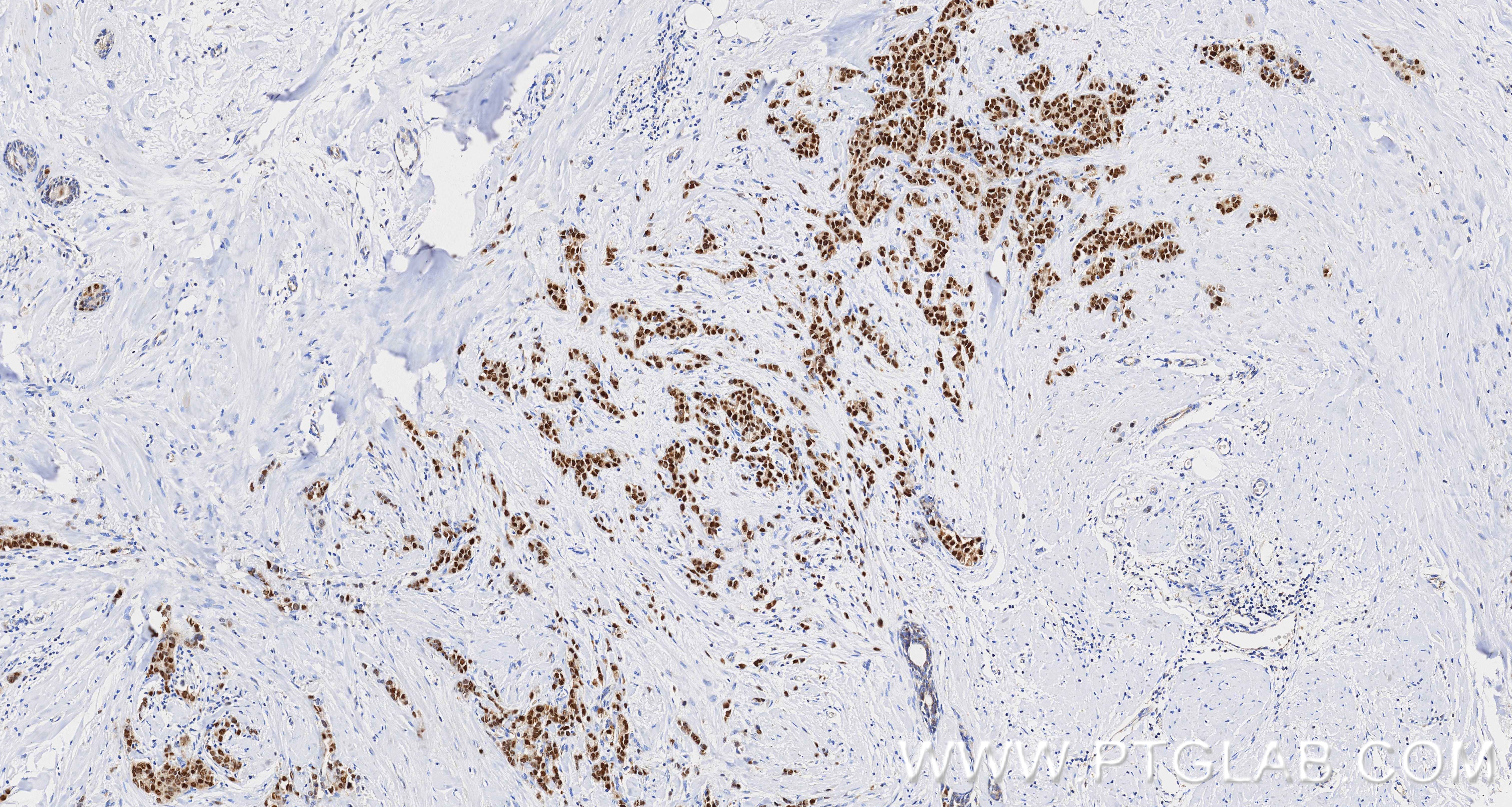 IHC staining of human breast cancer using 84564-11-RR IHC staining of human breast cancer using 84564-11-RR