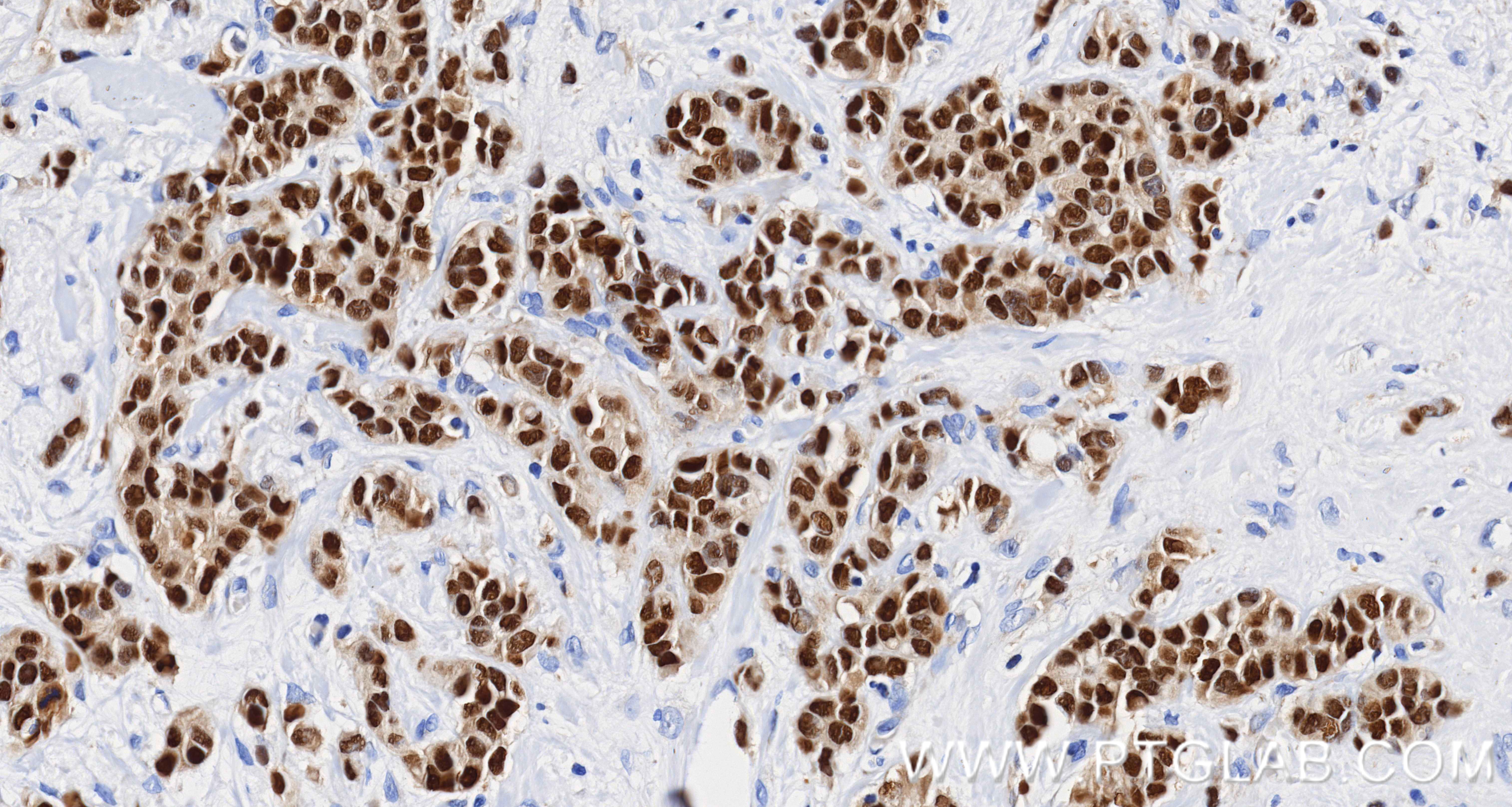IHC staining of human breast cancer using 84564-11-RR IHC staining of human breast cancer using 84564-11-RR