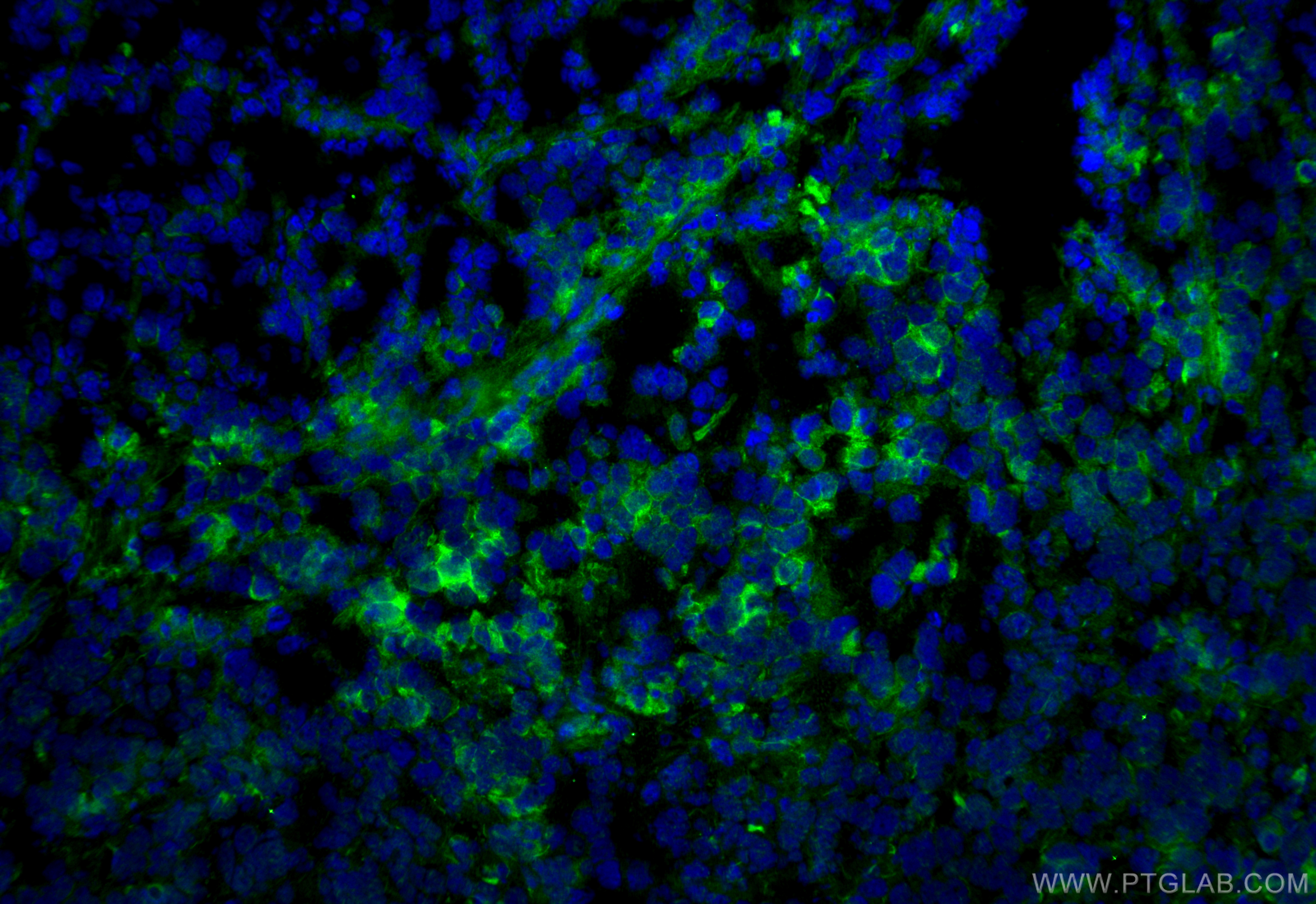 IF Staining of mouse breast cancer using 18299-1-AP