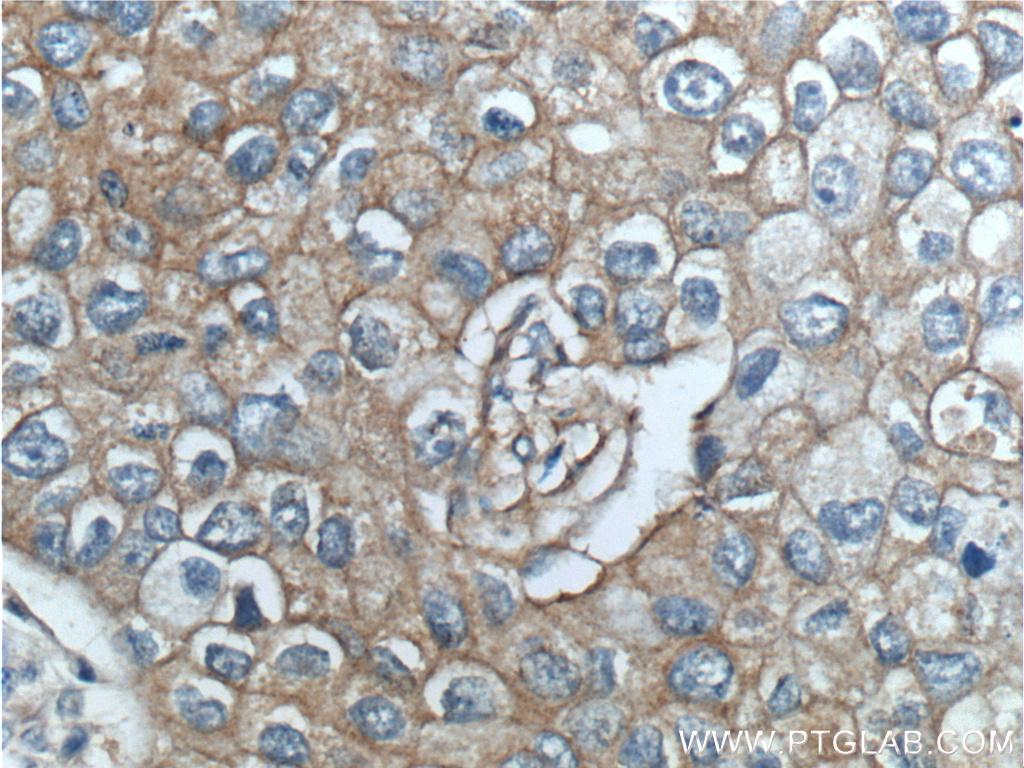 IHC staining of human breast cancer using 10369-1-AP