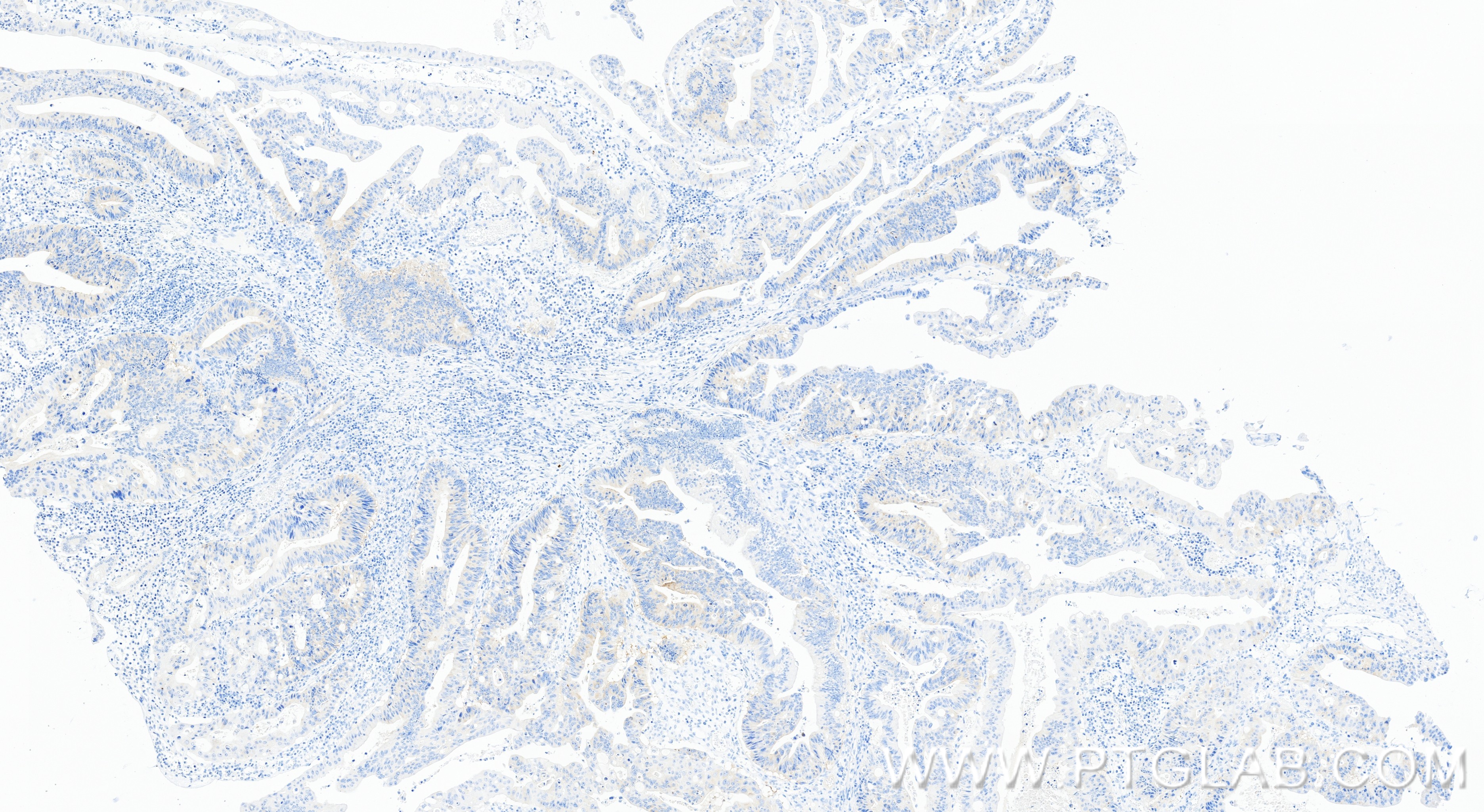 IHC staining of human colon cancer using 86688-1-RR (same clone as 86688-1-PBS) IHC staining of human colon cancer using 86688-1-RR (same clone as 86688-1-PBS)