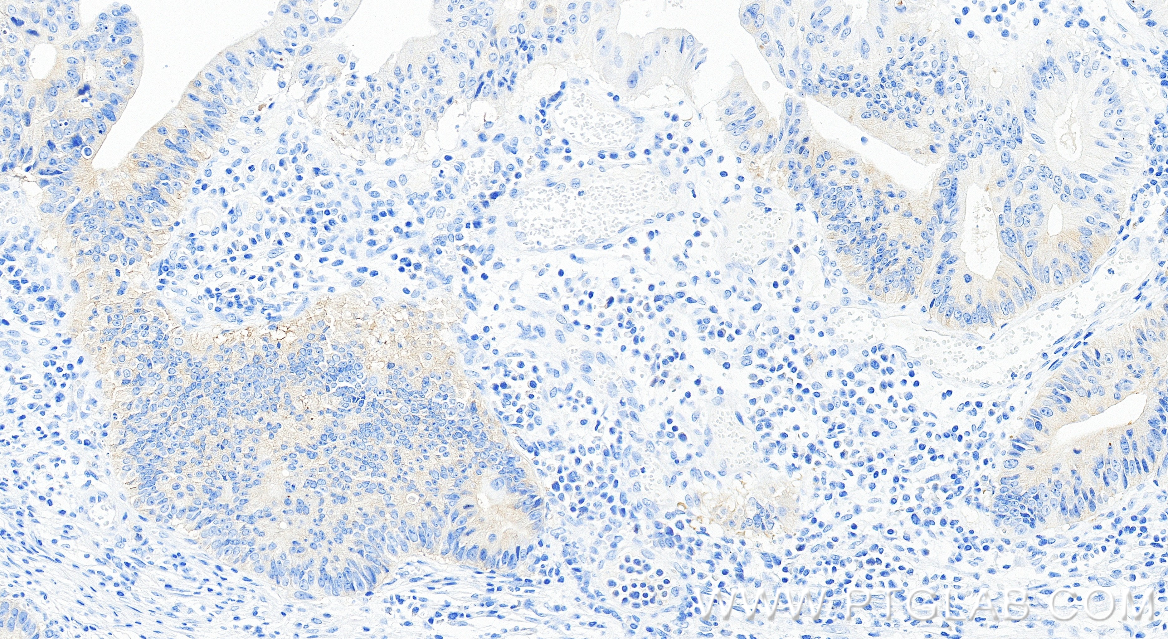 IHC staining of human colon cancer using 86688-1-RR (same clone as 86688-1-PBS) IHC staining of human colon cancer using 86688-1-RR (same clone as 86688-1-PBS)