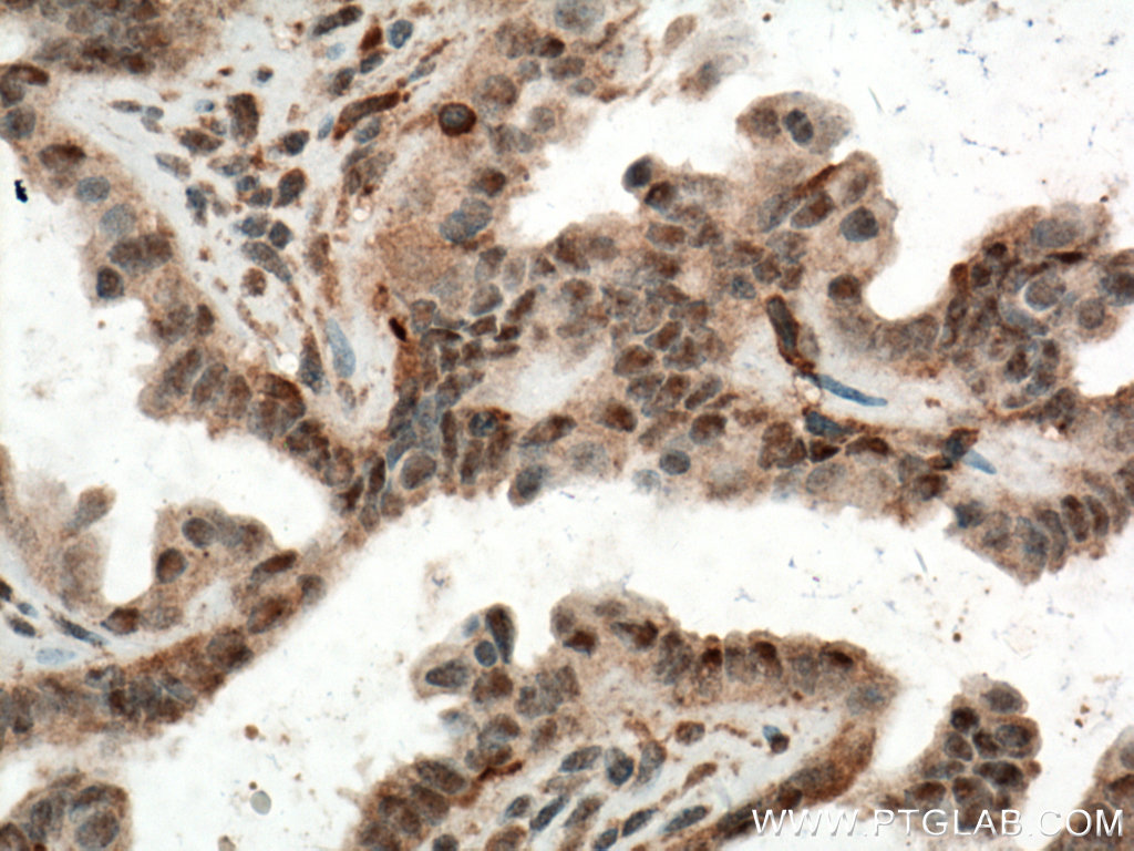 IHC staining of human ovary tumor using 66192-1-Ig