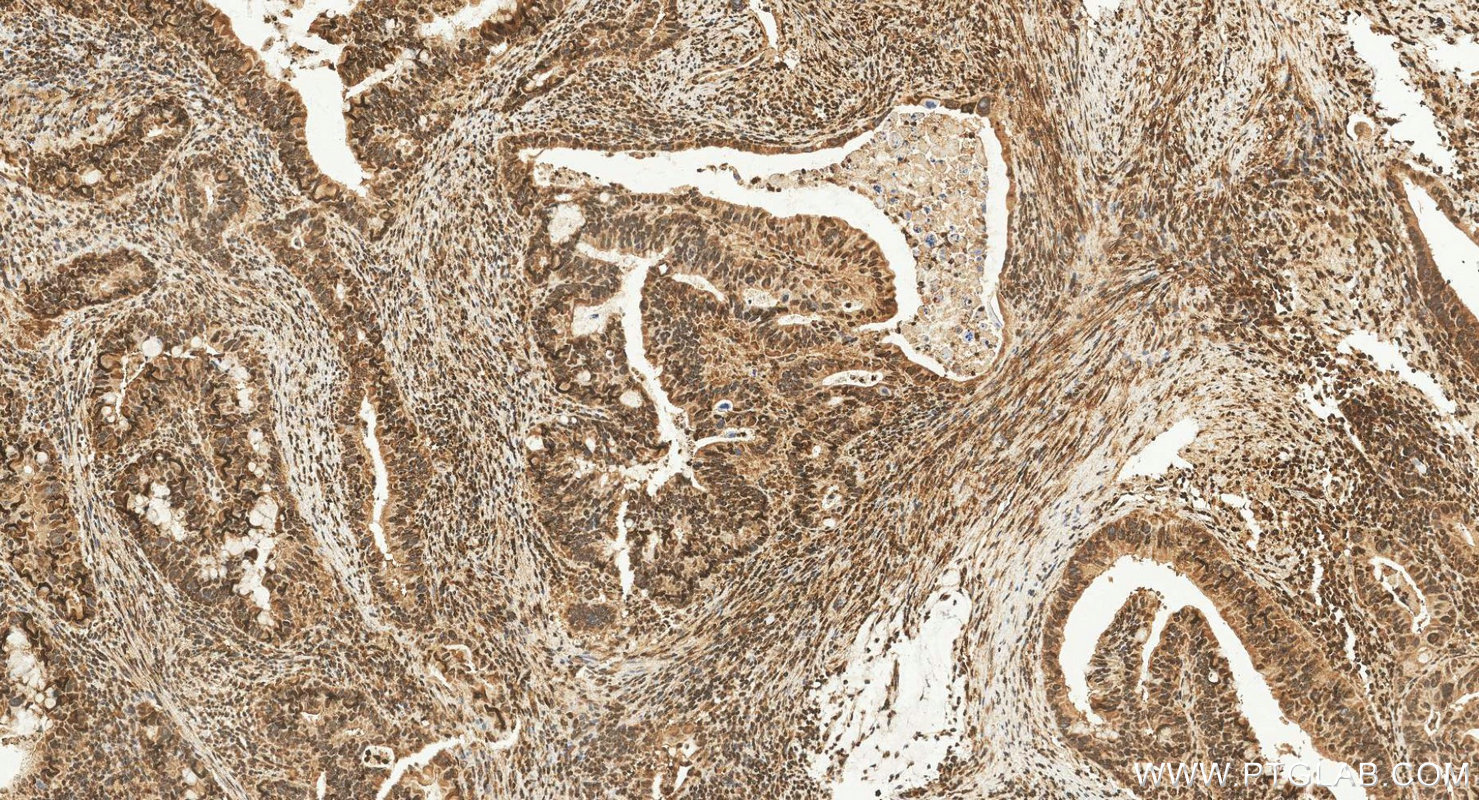 IHC staining of human colon cancer using 28733-1-AP IHC staining of human colon cancer using 28733-1-AP