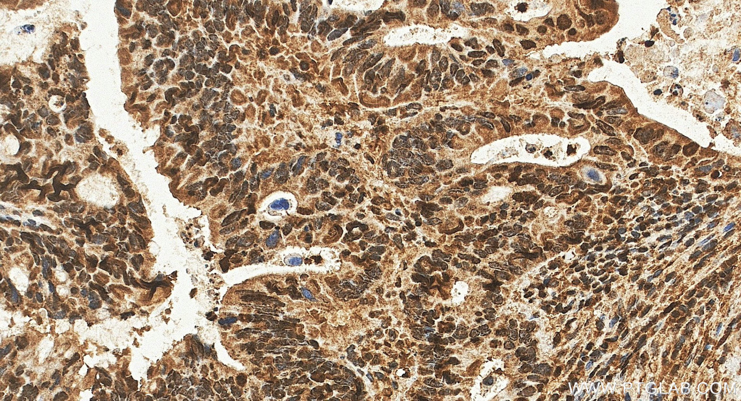 IHC staining of human colon cancer using 28733-1-AP IHC staining of human colon cancer using 28733-1-AP