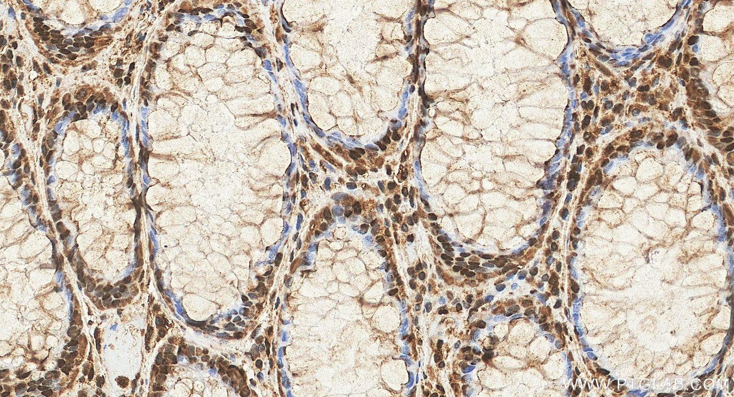 IHC staining of human colon cancer using 28733-1-AP IHC staining of human colon cancer using 28733-1-AP