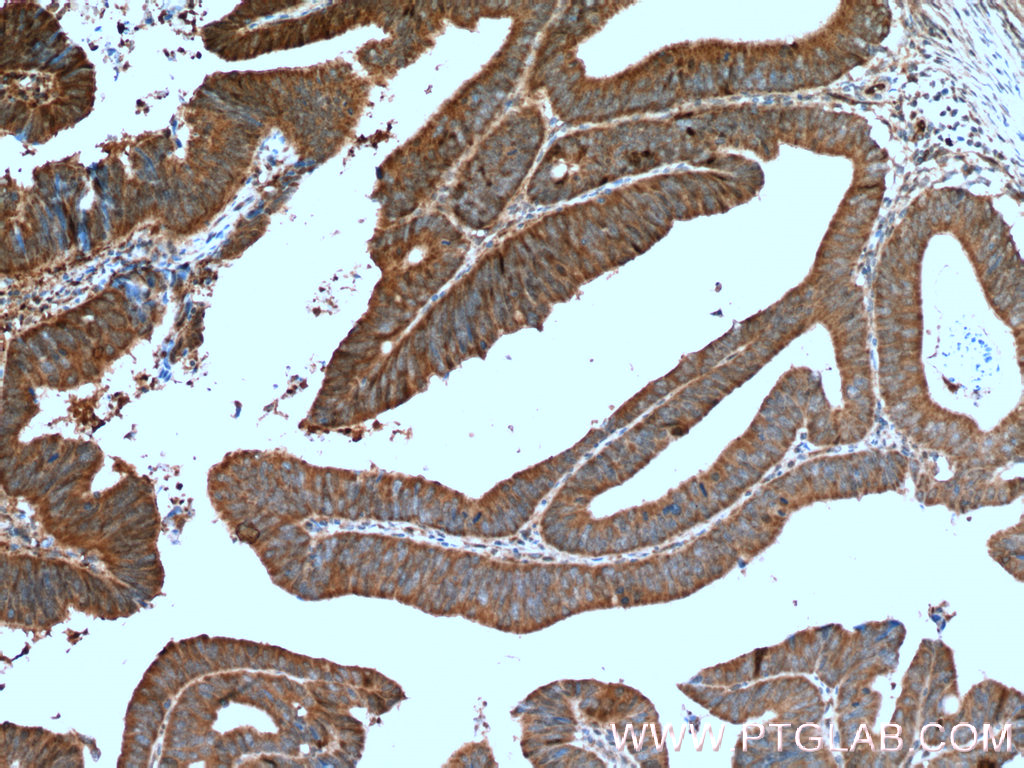 IHC staining of human colon cancer using 11257-1-AP