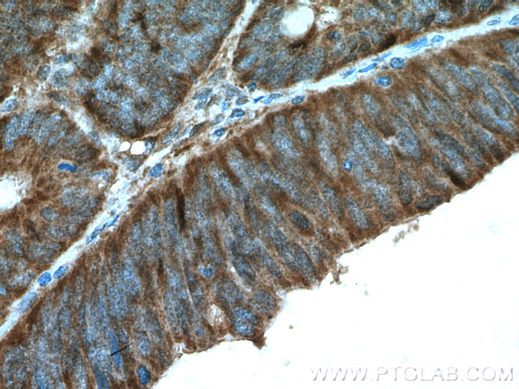 IHC staining of human colon cancer using 11257-1-AP