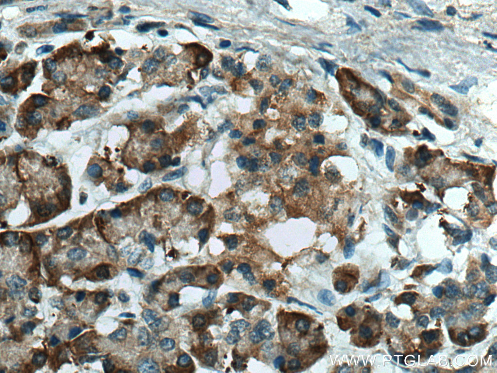 IHC staining of human pancreas cancer using 12007-1-AP (same clone as 12007-1-PBS)