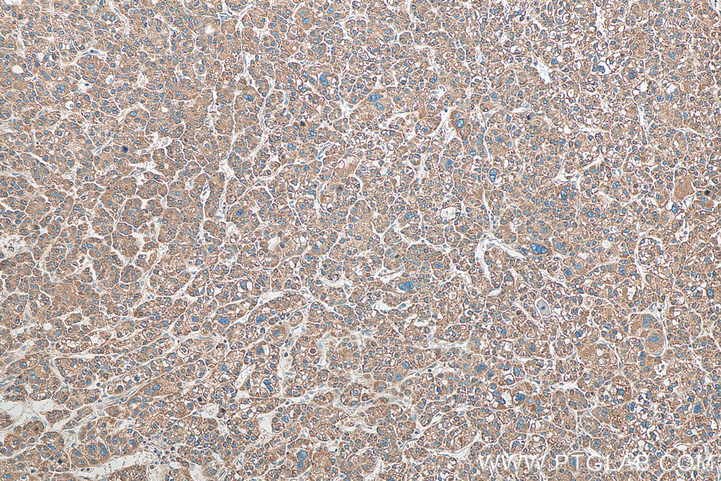 IHC staining of human liver cancer using 24344-1-AP