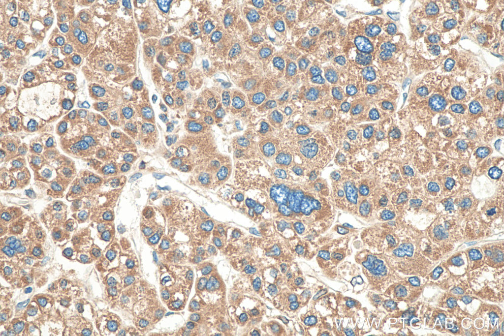 IHC staining of human liver cancer using 24344-1-AP
