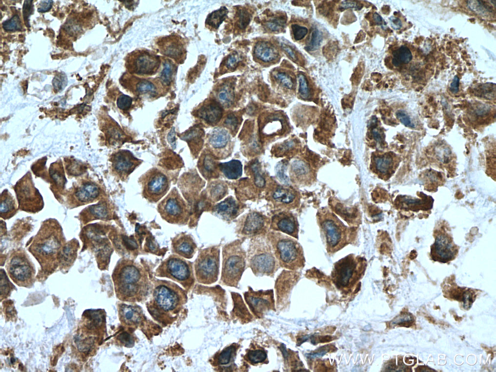 IHC staining of human breast cancer using 16016-1-AP