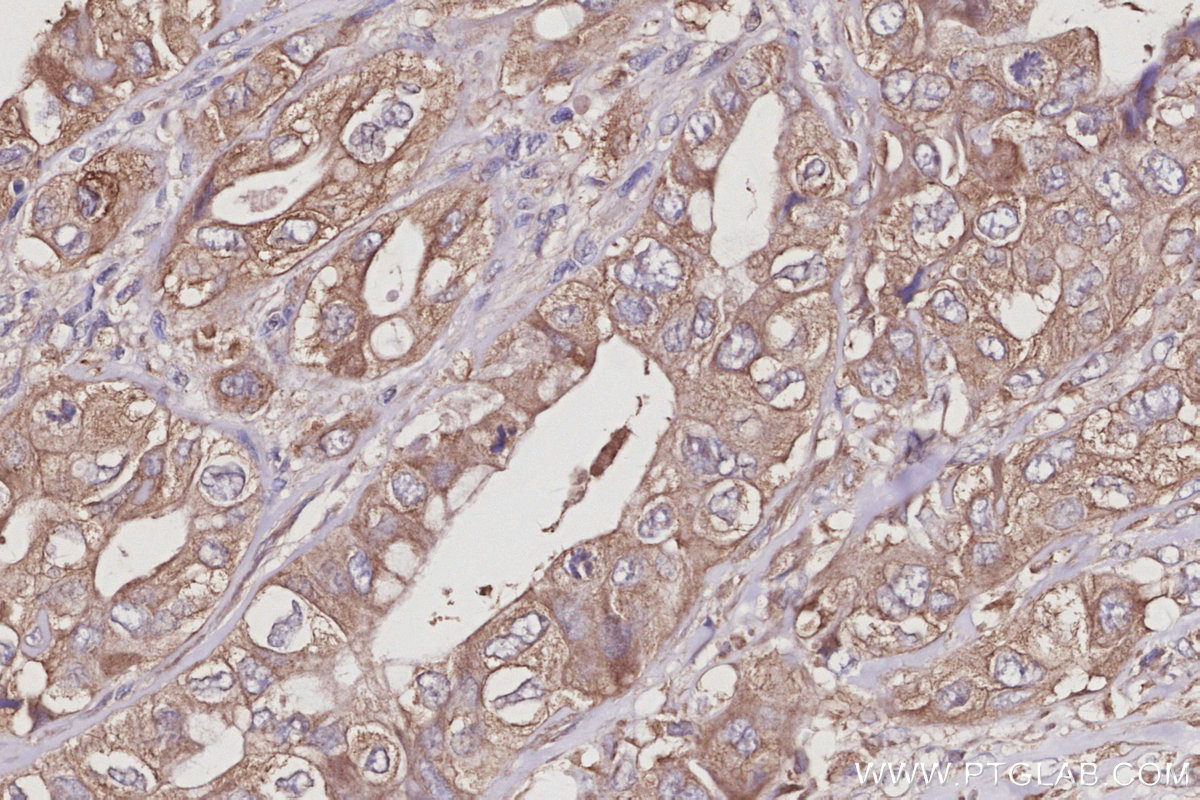 IHC staining of human pancreas cancer using 11630-1-AP IHC staining of human pancreas cancer using 11630-1-AP