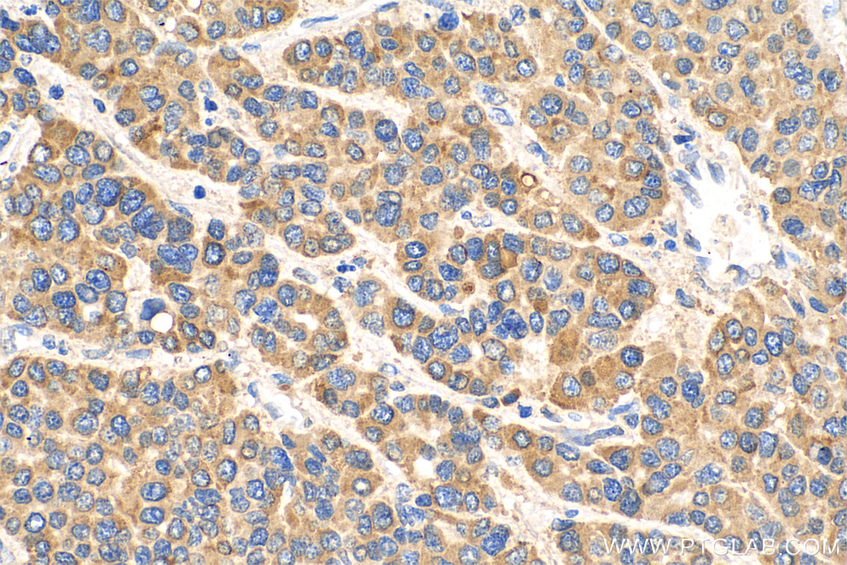 IHC staining of human liver cancer using 66365-1-Ig