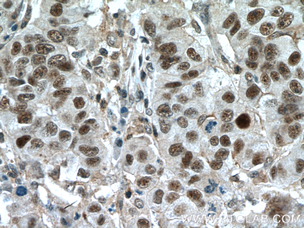 IHC staining of human prostate cancer using 55471-1-AP