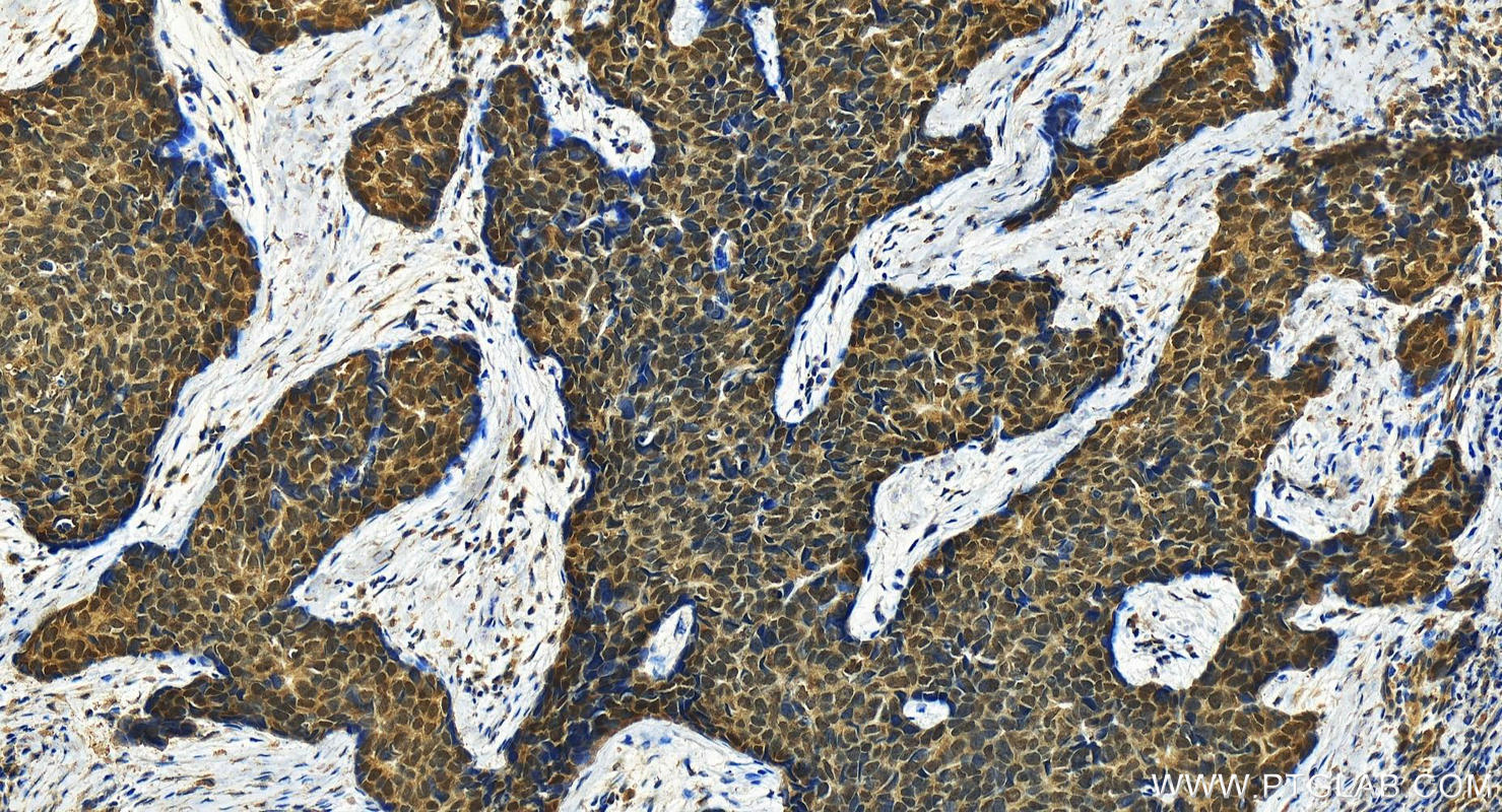 IHC staining of human bowen disease using 21045-1-AP