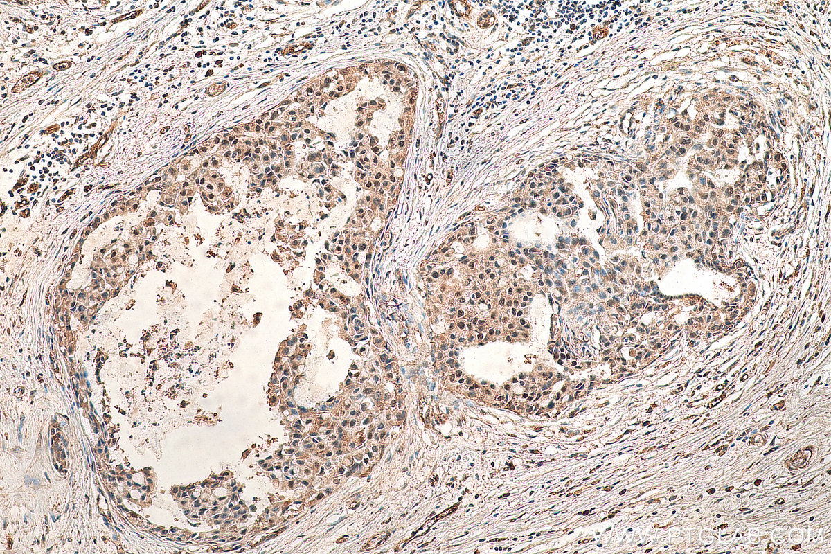IHC staining of human breast cancer using 23117-1-AP