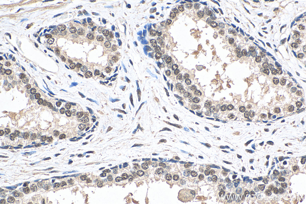 IHC staining of human prostate cancer using 66818-1-Ig