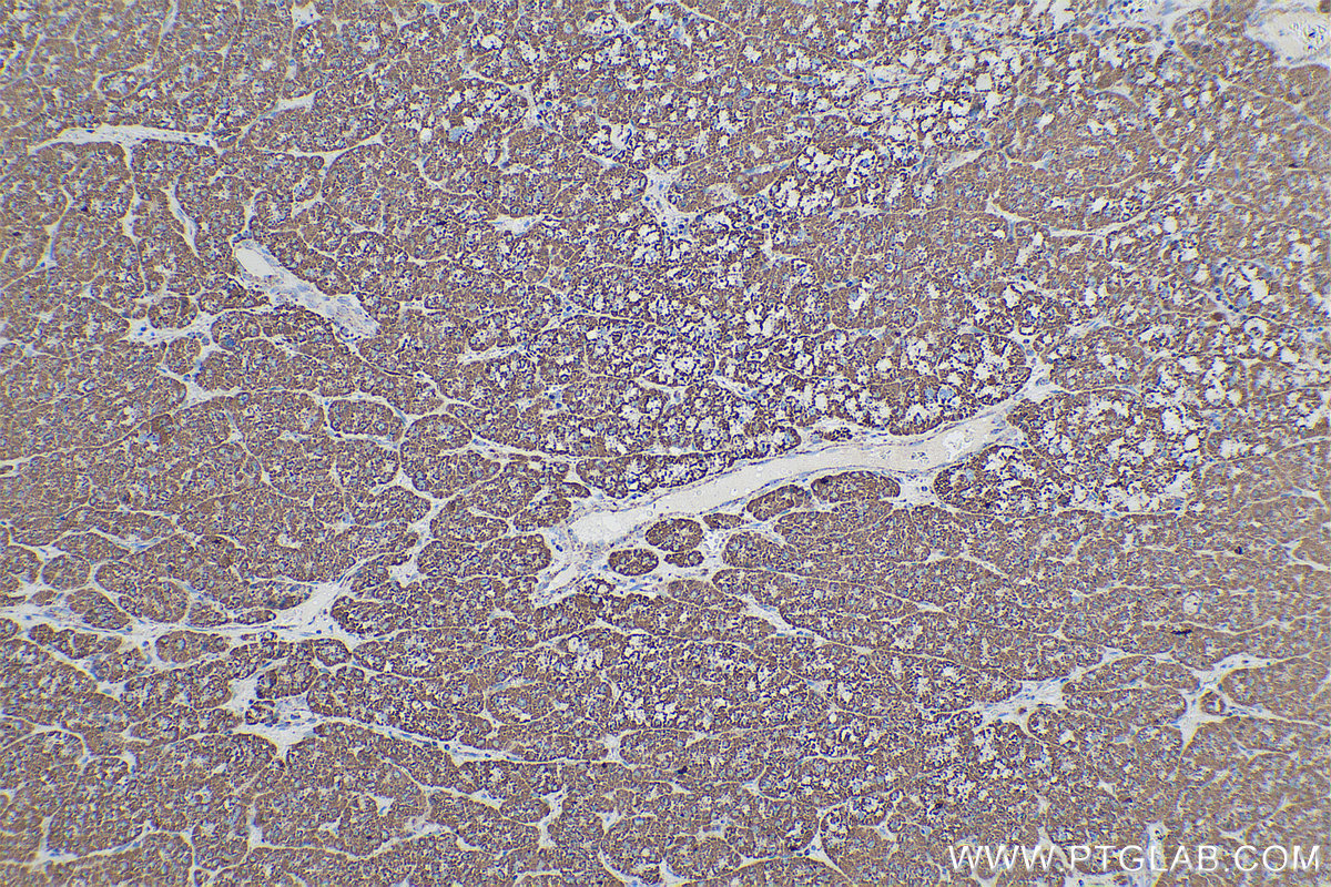 IHC staining of human liver cancer using 67661-1-Ig