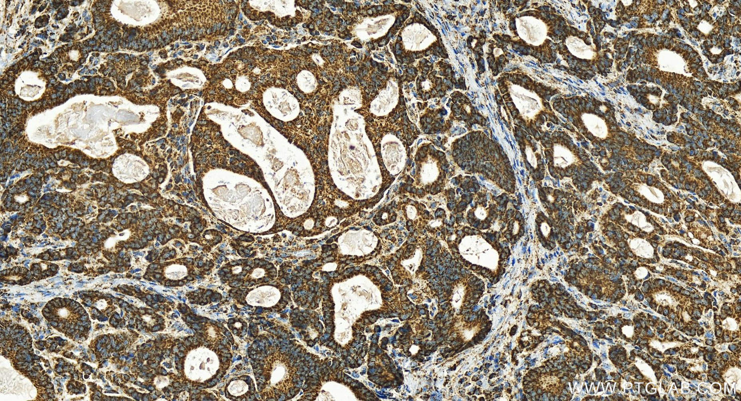 IHC staining of human stomach cancer using 17925-1-AP